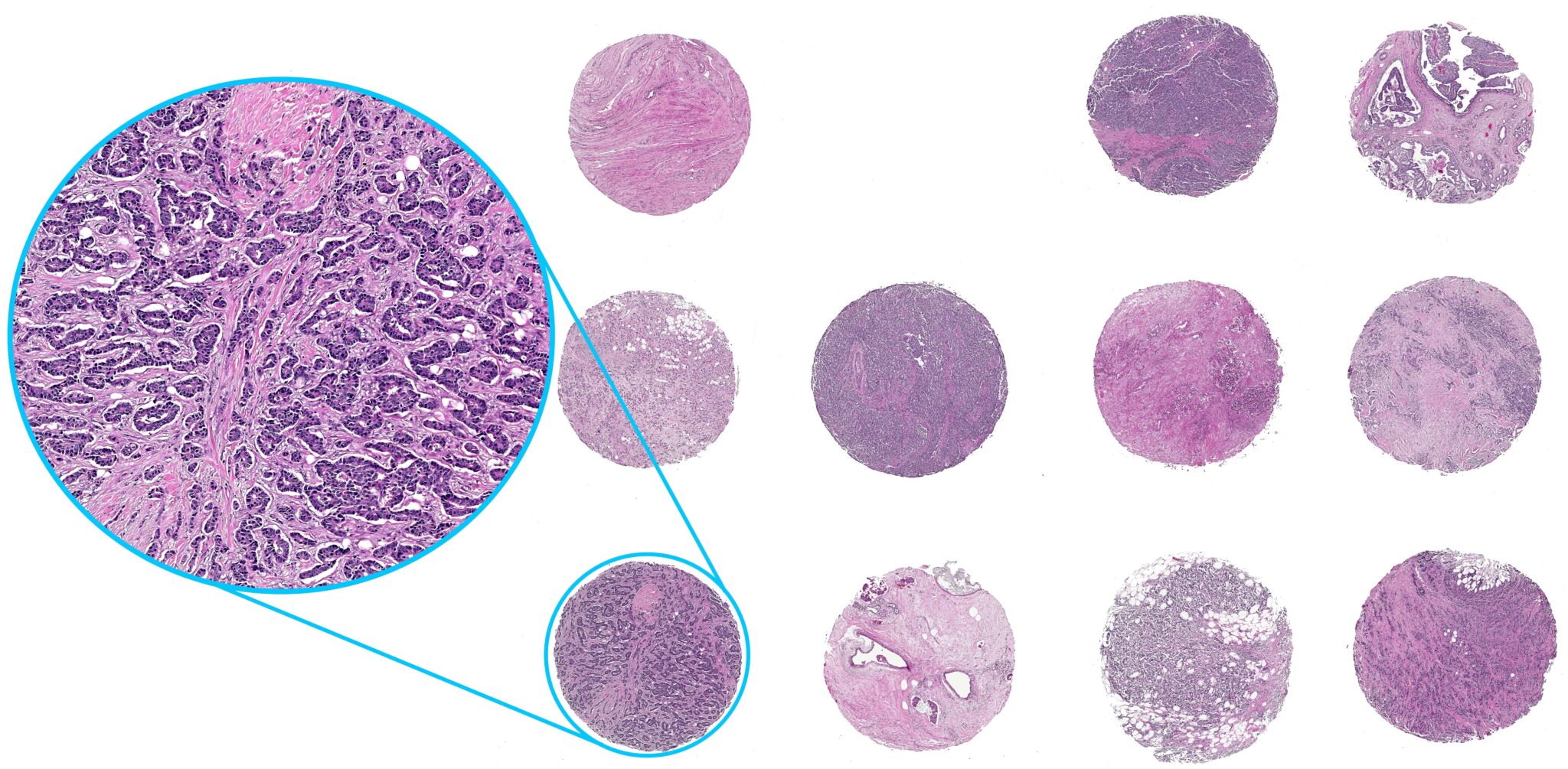 Tissue Microarrays Cancer Controls