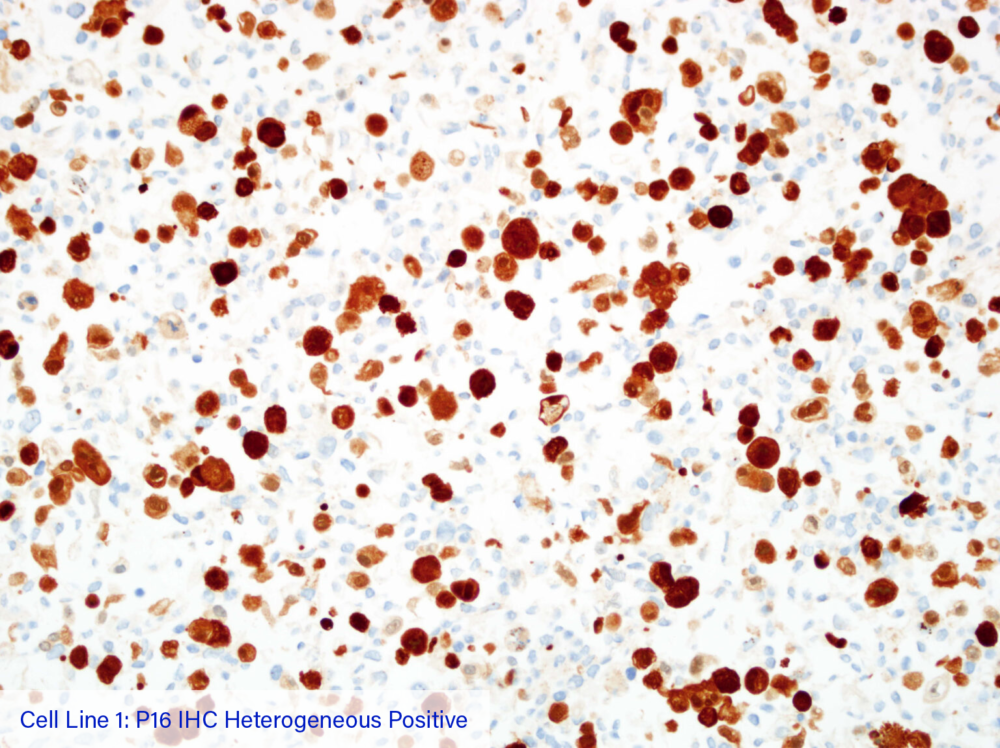 Cell Line 1: P16 IHC Heterogeneous Positive