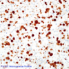 Cell Line 1: P16 IHC Heterogeneous Positive