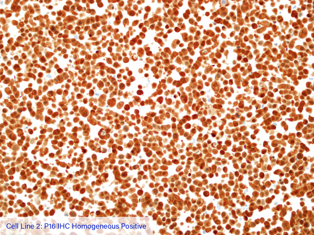 Cell Line 2: P16 IHC Homogeneous Positive