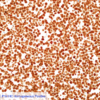 Cell Line 2: P16 IHC Homogeneous Positive