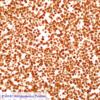 Cell Line 2: P16 IHC Homogeneous Positive