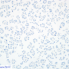 Cell Line 3: Negative P16 IHC