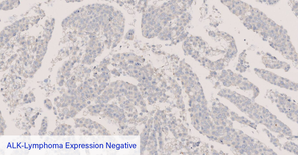 ALK-Lymphoma Expression Negative