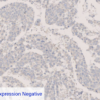 ALK-Lymphoma Expression Negative