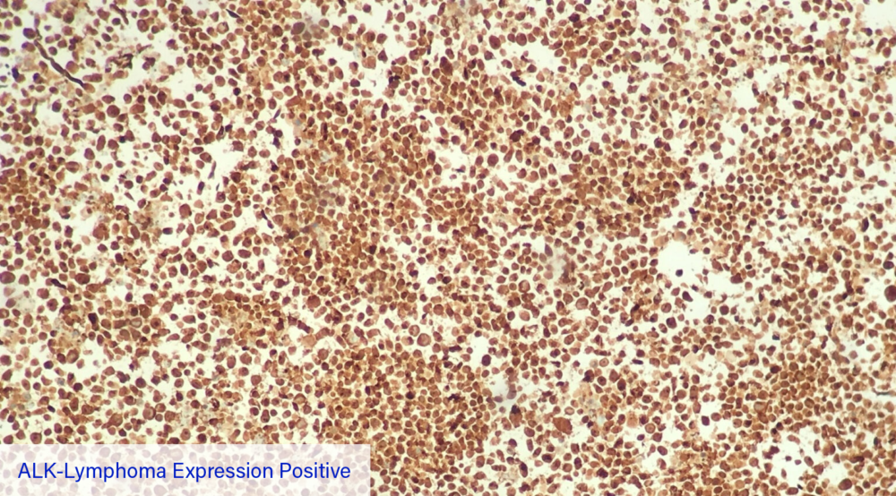 ALK-Lymphoma Expression Positive