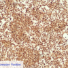 ALK-Lymphoma Expression Positive