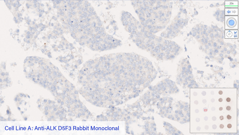 Cell Line A: Anti-ALK D5F3 Rabbit Monoclonal