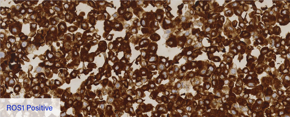 ROS1 Positive IHC