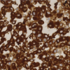 ROS1 Positive IHC