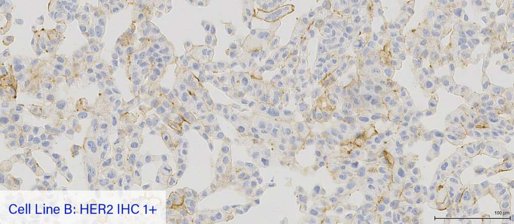 Cell Line B: HER2 IHC 1+