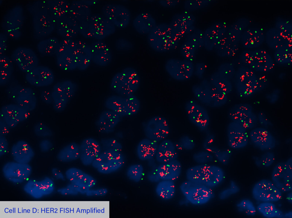 Cell Line D: HER2 FISH Amplified