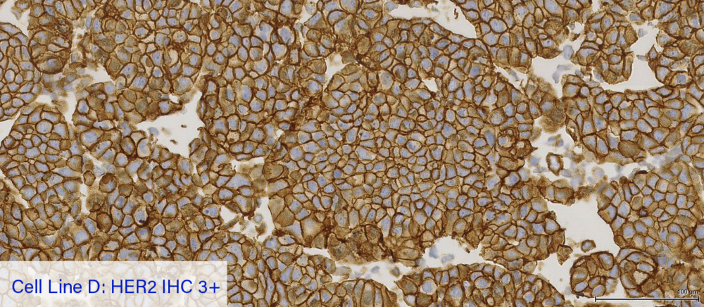 Cell Line D: HER2 IHC 3+