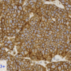 Cell Line D: HER2 IHC 3+