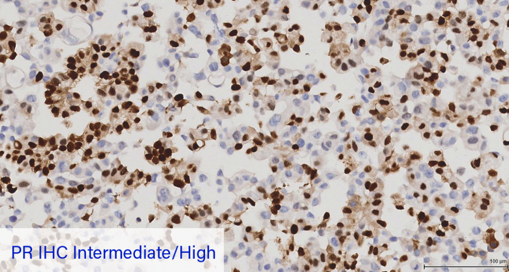 PR IHC Intermediate/High