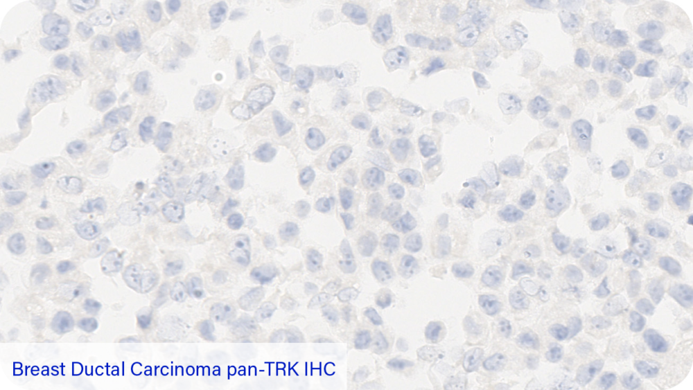 Breast Ductal Carcinoma pan-TRK IHC