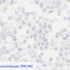 Breast Ductal Carcinoma pan-TRK IHC