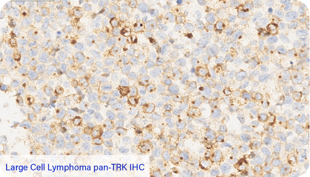 Large Cell Lymphoma pan-TRK IHC