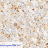 Large Cell Lymphoma pan-TRK IHC