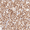 MSH2 Expression