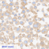 Pan Melanoma CC-BRS2064 BRAF V600E